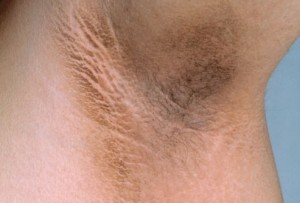 Acanthosis_Nigricans-aisselle