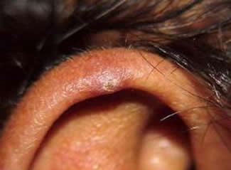 Nodule douloureux de l'oreille | Novaderm