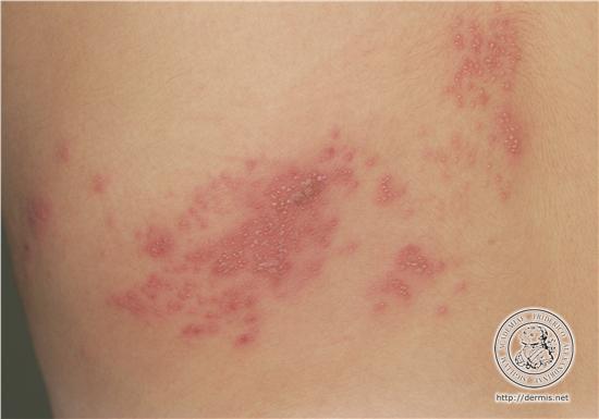 Picture of Shingles (Herpes Zoster) - WebMD