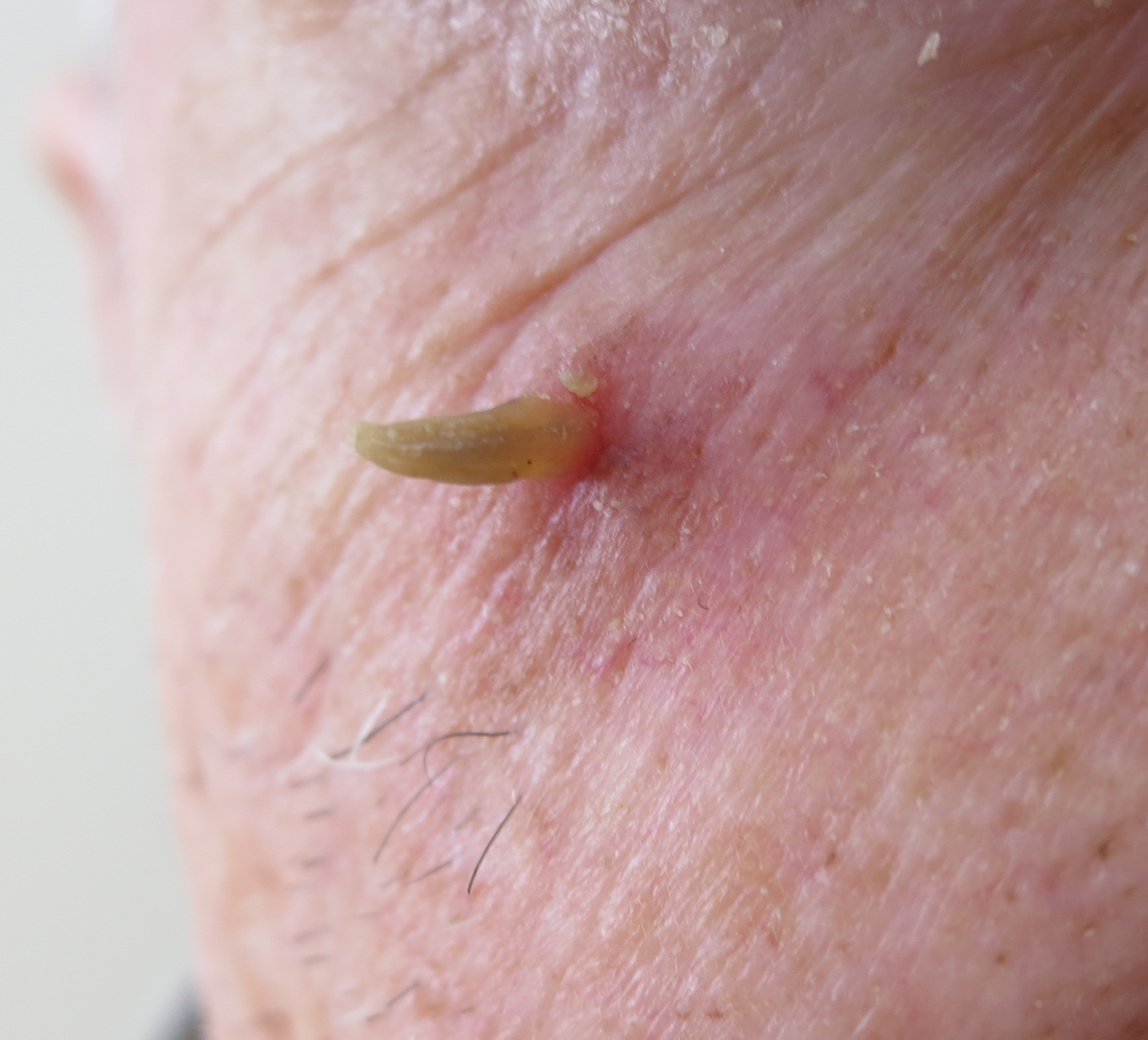 Picture of Actinic Keratosis (Solar Keratosis) - WebMD
