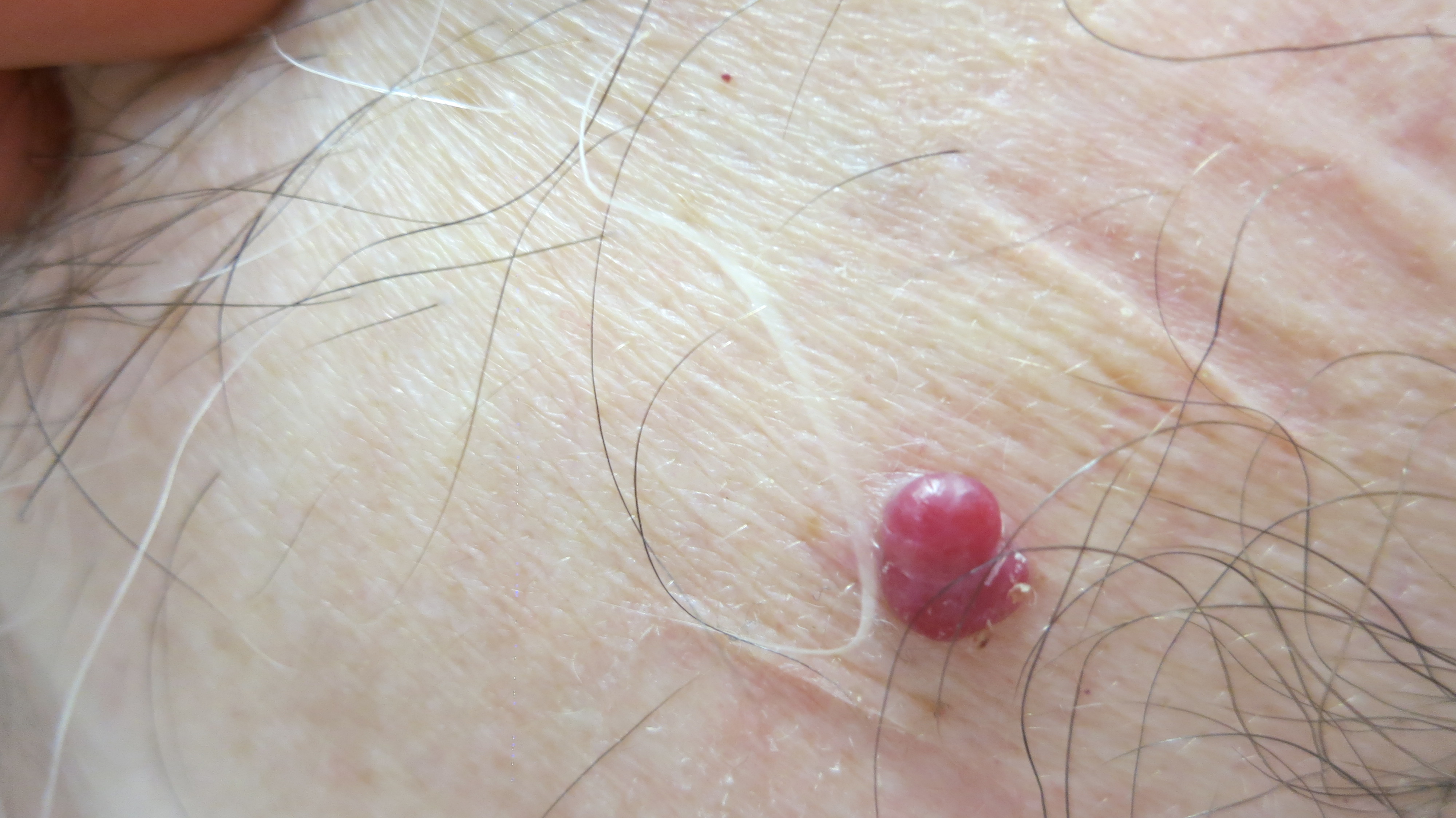 Skin Tags (Acrochordon) Guide: Causes, Symptoms and ...